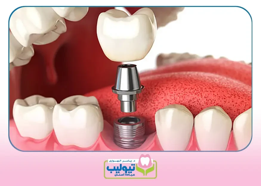 تعديل الأسنان بالتقويم image